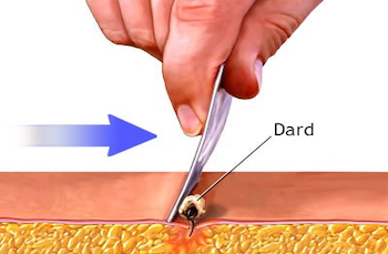 Enlever dard 1